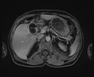 Bouveret syndrome (Radiopaedia 61017-68856 Axial T1 C+ fat sat 29).jpg