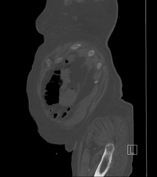 Bowel ischemia secondary to SMA occlusion with extensive portomesenteric venous gas (Radiopaedia 54656-60871 Sagittal bone window 106).jpg