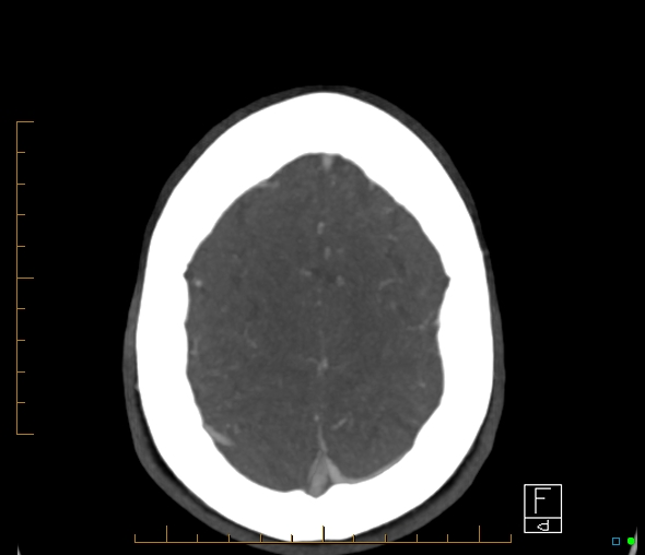 Brachiocephalic trunk stenosis (Radiopaedia 87242-103519 A 10).jpg