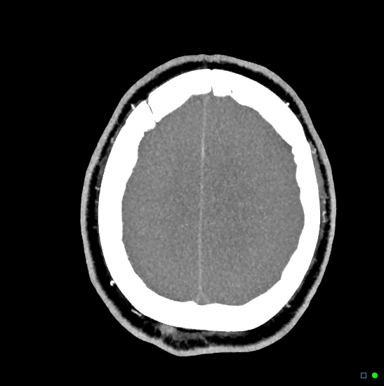 Brain death on MRI and CT angiography (Radiopaedia 42560-45841 B 12).jpg