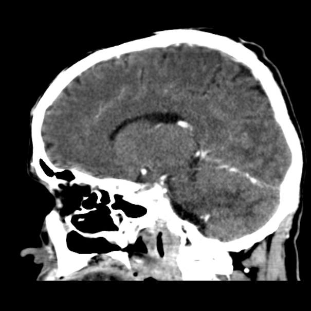 Brain metastases from lung cancer (Radiopaedia 24480-24781 C+ delayed 25).jpg