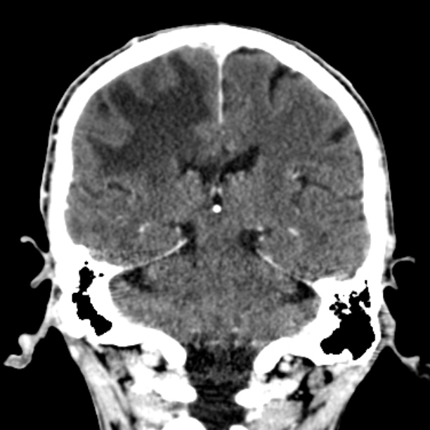 Brain metastases from lung cancer (Radiopaedia 27849-28092 Coronal C+ delayed 40).jpg