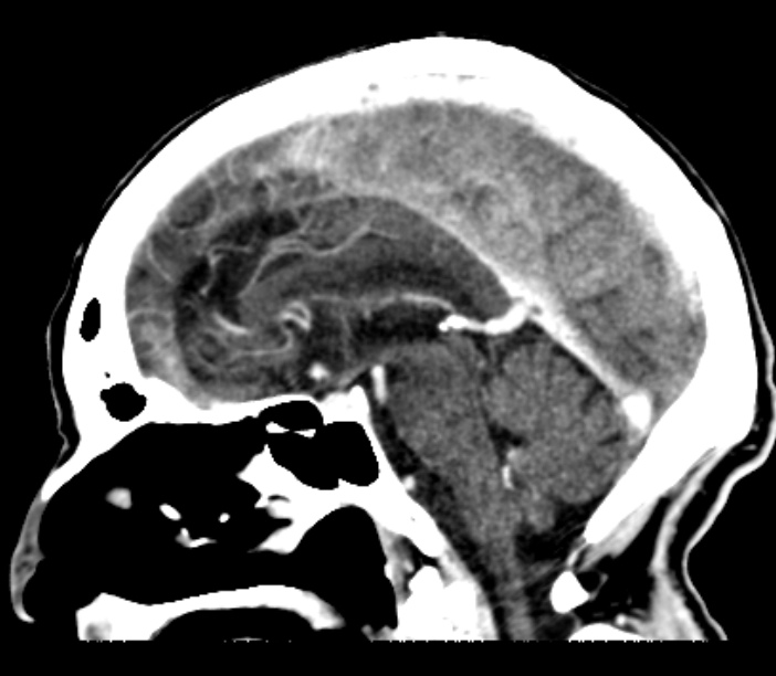 Brain metastases from lung cancer (Radiopaedia 27849-28092 Sagittal C+ delayed 32).jpg