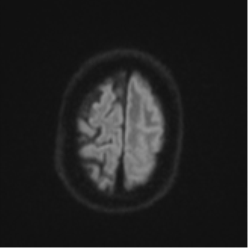 File:Brain metastasis (lung cancer) (Radiopaedia 48289-53179 Axial DWI 53).png