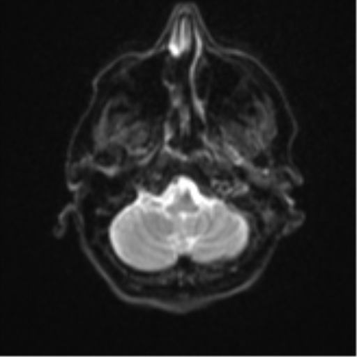 Brain metastasis (sarcoma) (Radiopaedia 47576-52209 Axial DWI 5).png