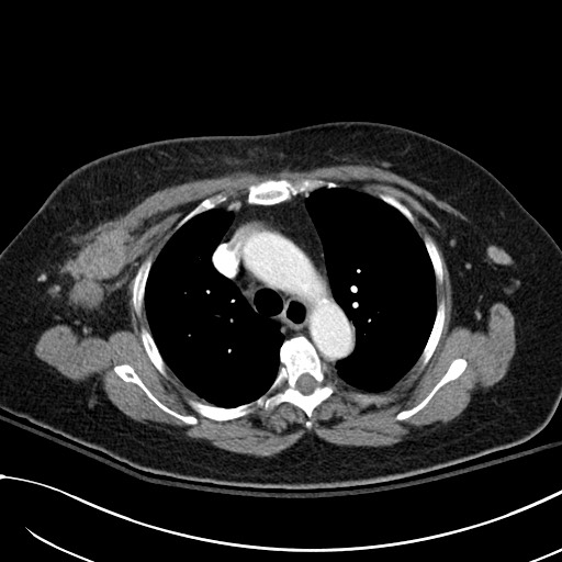 File:Breast carcinoma with pathological hip fracture (Radiopaedia 60314-67974 A 18).jpg