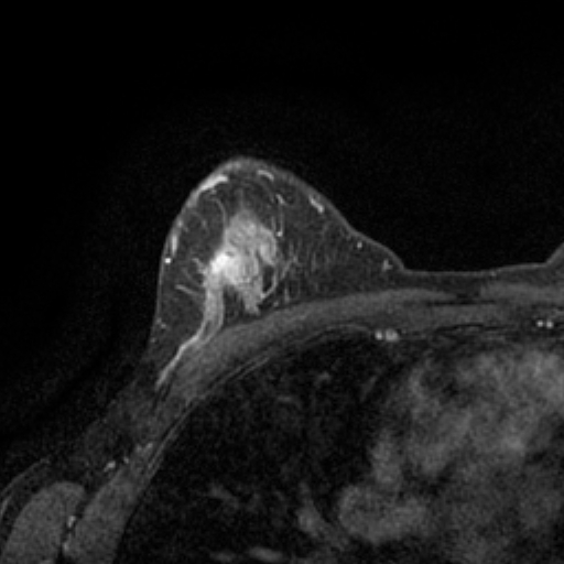 File:Breast lipoma and cancer (Radiopaedia 15118-14995 C 5).jpg