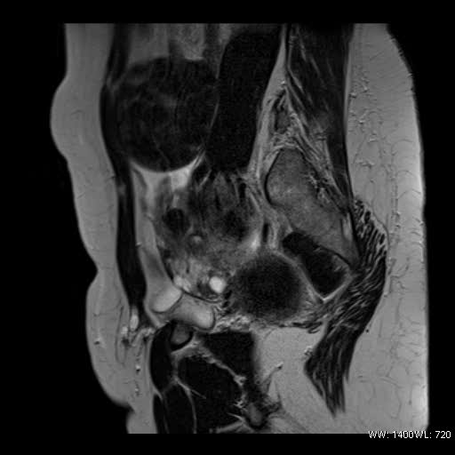 File:Broad ligament fibroid (Radiopaedia 49135-54241 Sagittal T2 7).jpg