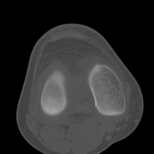Brodie abscess of the tibia (Radiopaedia 58984-66250 Axial bone window 50).jpg