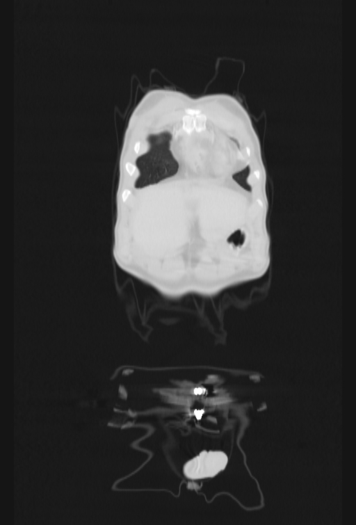 Bronchial carcinoid tumor (Radiopaedia 57187-64090 Coronal lung window 3).jpg