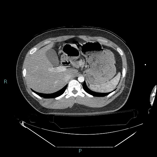 Bronchial carcinoid tumor (Radiopaedia 78272-90870 B 116).jpg