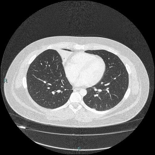 Bronchial carcinoid tumor (Radiopaedia 78272-90875 Axial lung window 32).jpg