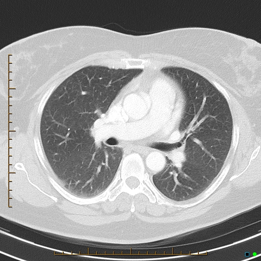 Bronchial diverticula (Radiopaedia 79512-92675 Axial lung window 22).jpg