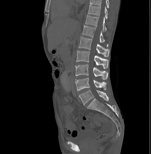 File:Bronchiectasis in Crohn disease (Radiopaedia 60311-67977 Sagittal bone window 123).jpg