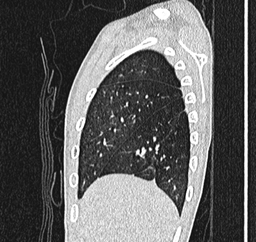 Bronchiolitis obliterans (Radiopaedia 71538-81897 Sagittal lung window 9).jpg