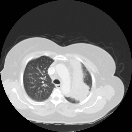 Bronchogenic carcinoma (Radiopaedia 73497-84262 Axial lung window 26).jpg