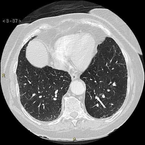Bronchogenic carcinoma as an incidental finding (Radiopaedia 16453-16130 Axial lung window 37).jpg