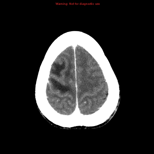 File:Bronchogenic carcinoma brain metastasis (Radiopaedia 9286-9970 B 25).jpg