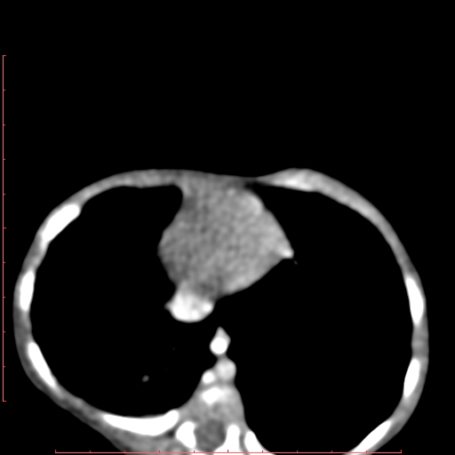 Bronchogenic cyst (Radiopaedia 78599-91409 B 153).jpg