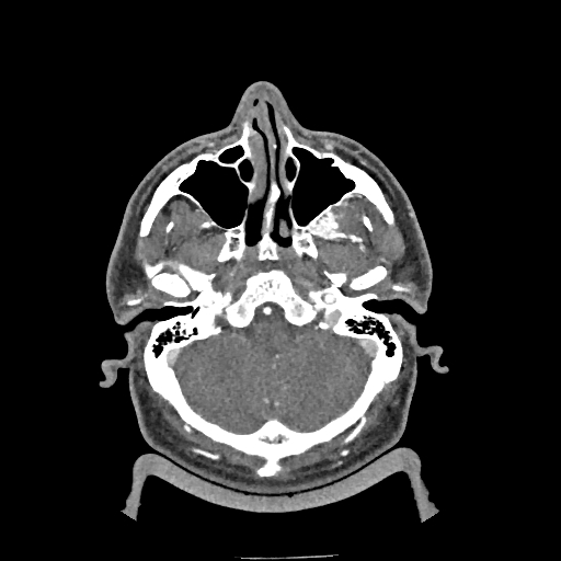Buccal fat pad arteriovenous malformation (Radiopaedia 70936-81144 D 246).jpg