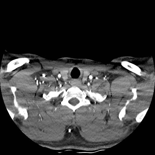 Buccal fat pad arteriovenous malformation (Radiopaedia 70936-81144 D 59).jpg