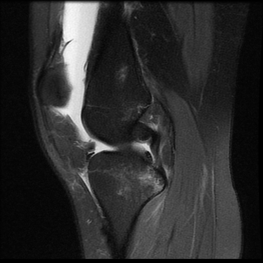 File:Bucket handle meniscus tear (Radiopaedia 56916-63751 Sagittal PD fat sat 12).jpg