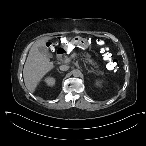 Buried bumper syndrome - gastrostomy tube (Radiopaedia 63843-72577 Axial Inject 29).jpg