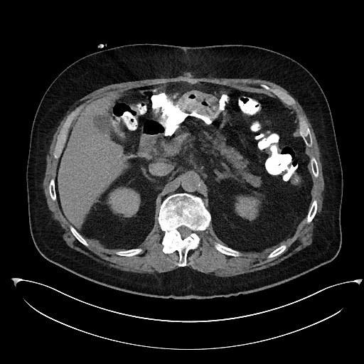 File:Buried bumper syndrome - gastrostomy tube (Radiopaedia 63843-72577 Axial Inject 30).jpg