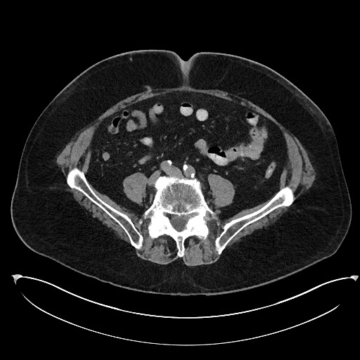 Buried bumper syndrome - gastrostomy tube (Radiopaedia 63843-72577 Axial Inject 81).jpg
