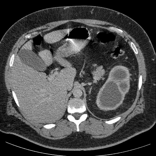 File:Burned-out testicular seminoma - retroperitoneal nodal metastases (Radiopaedia 62872-71245 A 18).jpg