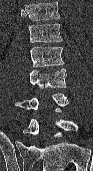 File:Burst fracture (Radiopaedia 53373-59357 Coronal bone window 41).jpg