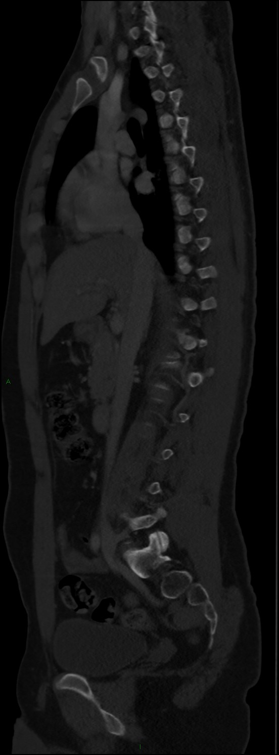 Burst fracture (Radiopaedia 83168-97542 Sagittal bone window 60).jpg
