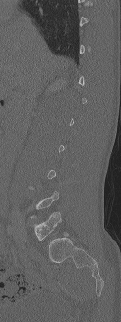 Burst fracture - T12 with conus compression (Radiopaedia 56825-63647 Sagittal bone window 61).png