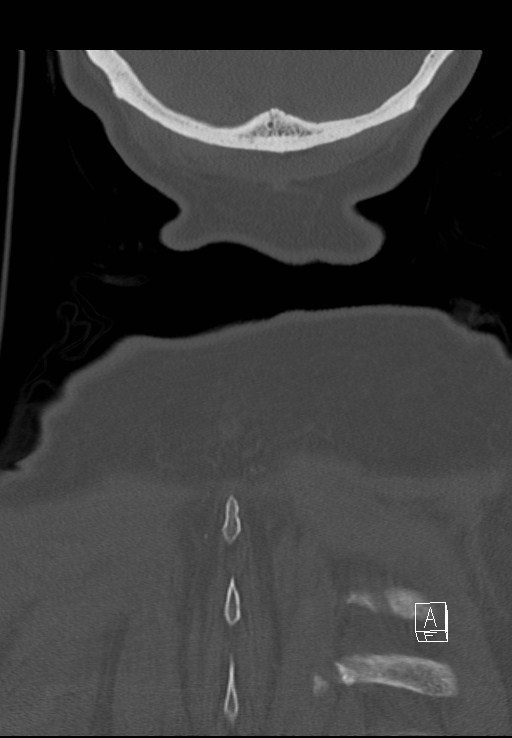 C1 and C2 (peg) fractures (Radiopaedia 36618-38184 Coronal bone window 57).jpg