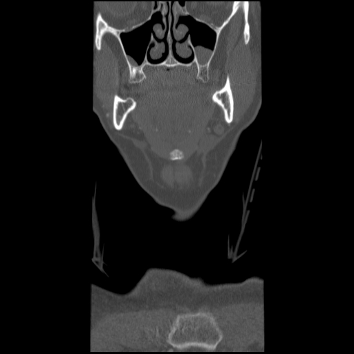 File:C1 anterior arch (plough) fracture - type 1 (Radiopaedia 76181-87720 Coronal bone window 94).jpg