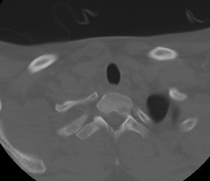 C7 laminar fracture and Klippel-Feil syndrome (Radiopaedia 86710-102850 Axial bone window 68).jpg