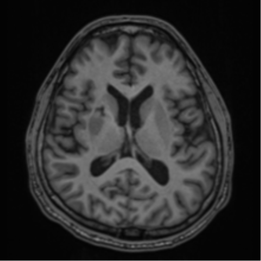 CNS vasculitis (Radiopaedia 55715-62263 Axial T1 37).png