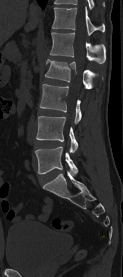 Calcaneal fractures with associated L2 burst fracture (Radiopaedia 71671-82493 Sagittal bone window 35).jpg