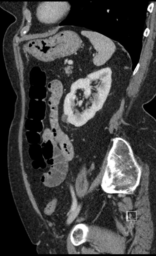 Calcified adrenal glands and Spigelian hernia (Radiopaedia 49741-54988 C 46).jpg