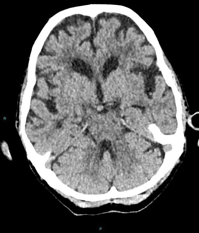 Calcified cerebral emboli from left ventricular thrombus (Radiopaedia 84420-99758 Axial non-contrast 62).jpg