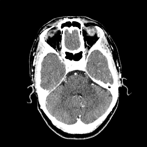 Calcified cerebral hydatid cyst (Radiopaedia 65603-74717 Axial with contrast 17).jpg