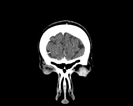 File:Calcified cerebral hydatid cyst (Radiopaedia 65603-74717 C 2).jpg