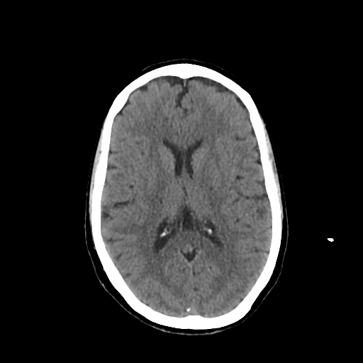 File:Calcified meningioma - cervical canal (Radiopaedia 70136-80171 Axial non-contrast 15).jpg