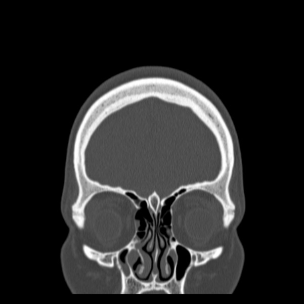 Calvarial osteoma (Radiopaedia 36520-38079 C 18).jpg