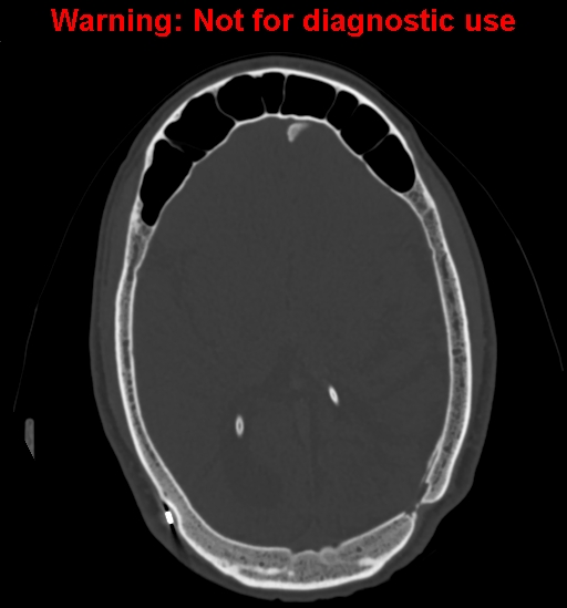 Calvarial thickening from chronic shunting (Radiopaedia 60079-67637 Axial bone window 101).jpg