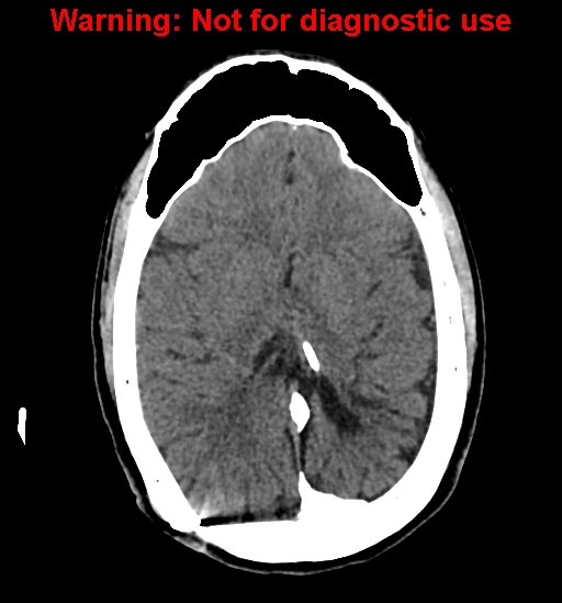 File:Calvarial thickening from chronic shunting (Radiopaedia 60079-67637 Axial non-contrast 18).jpg