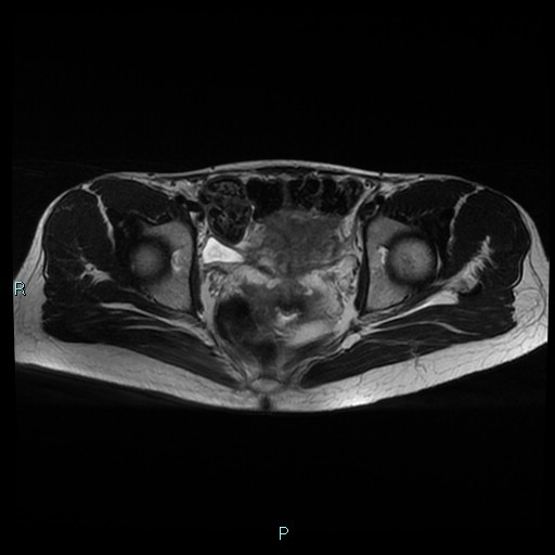 File:Canal of Nuck cyst (Radiopaedia 55074-61448 Axial T2 12).jpg