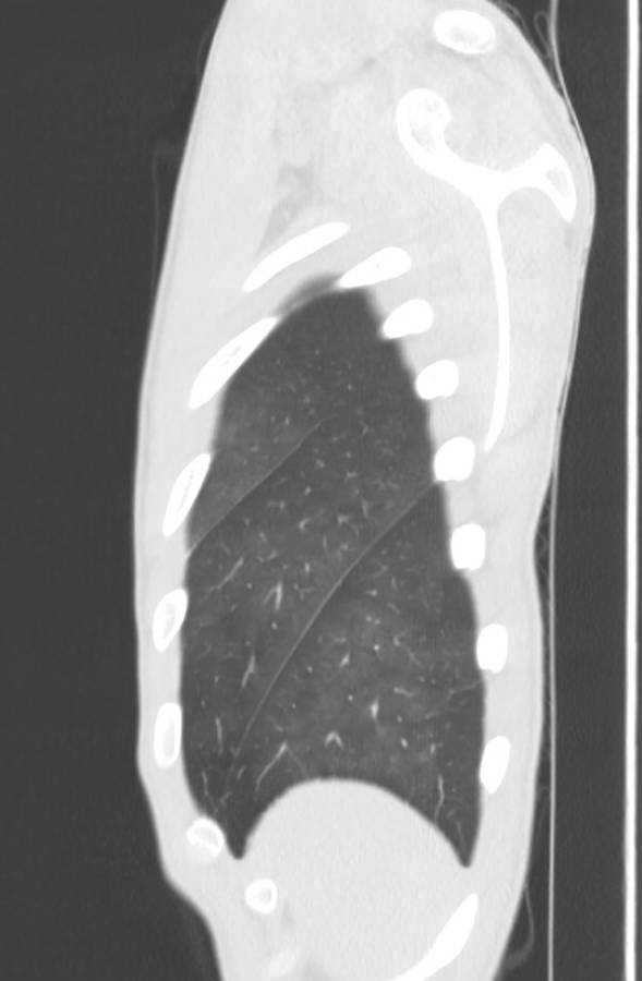 Cannabis-induced diffuse alveolar hemorrhage (Radiopaedia 89834-106946 Sagittal lung window 129).jpg