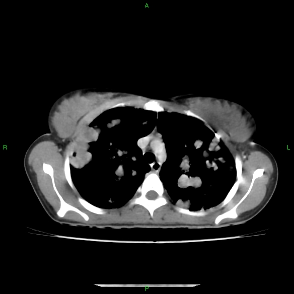 File:Cannon ball metastases - synovial sarcoma (Radiopaedia 26135-26271 C 11).jpg