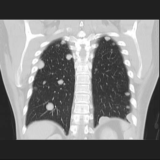 File:Cannonball pulmonary metastases (Radiopaedia 67684-77101 C 20).jpg
